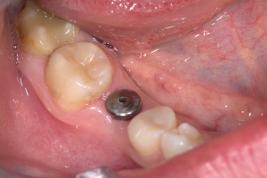 Hambaimplantaadid